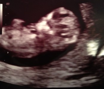 12 week ultrasound