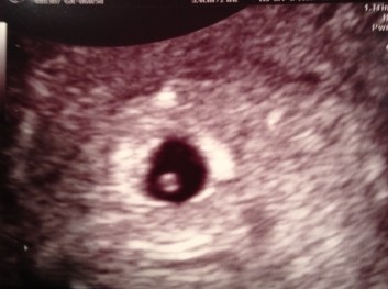 5 weeks 1 day ultrasound