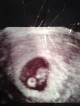 7 weeks:5 days ultrasound